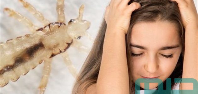 تفسير حلم رؤية القمل في الشعر للمتزوجه وقتله في المنام وعلاقته بالأرهاق 1 حلم القمل في الشعر للمتزوجه