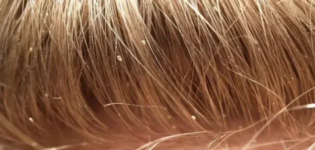 هل حلم القمل له علاقة بنوع الجنين للحامل 1 هل حلم القمل له علاقة بنوع الجنين للحامل؟