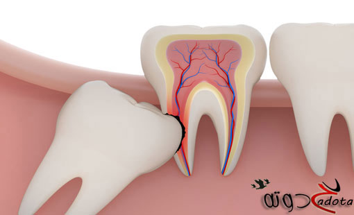 تفسير رؤية ضرس العقل في المنام