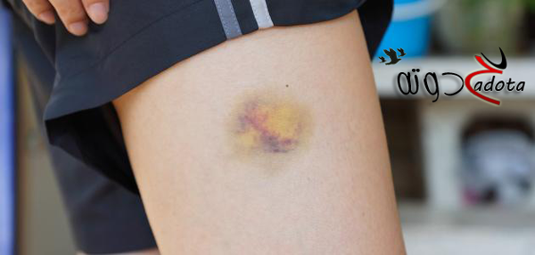 تفسير رؤية كدمات زرقاء في المنام