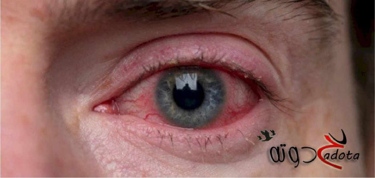 تفسير رؤية احمرار العين في المنام