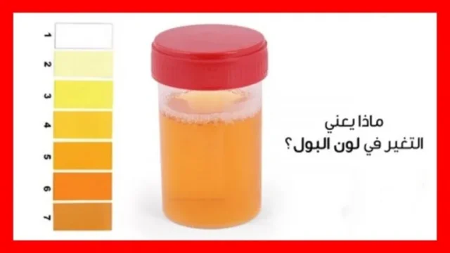 تفسير تغير لون البول