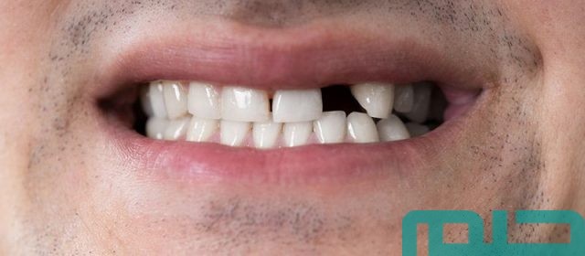 سبب تكرار حلم سقوط